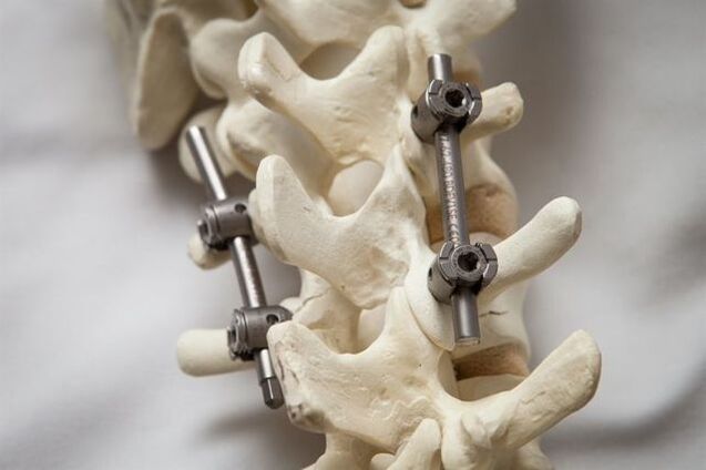 Fixatioun vun der Wirbelsäule Osteochondrose vum Hals