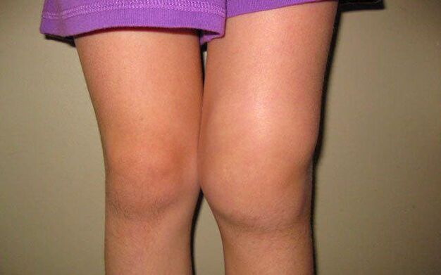 geschwollen Kniegelenk duerch Osteoarthritis