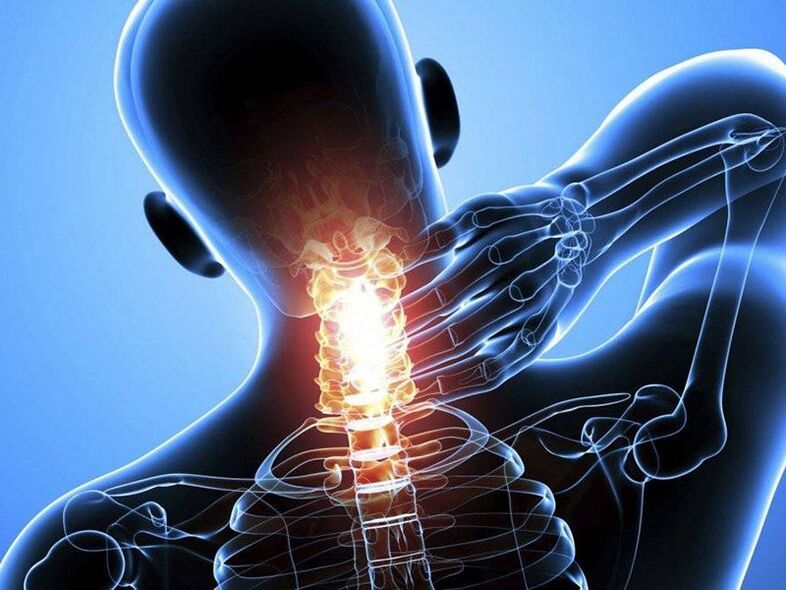 Osteochondrose vun der Gebärmutterkierper gëtt begleet vu Schmerz am Hals