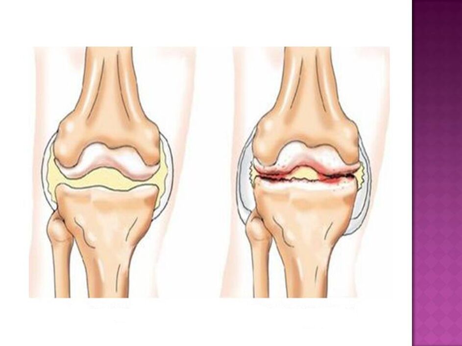D'Gelenk ass normal (lénks) a beaflosst vun Osteoarthritis (riets)