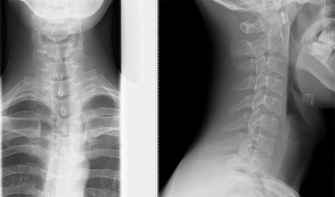 Röntgen vun der Wirbelsäule ass eng einfach an effektiv Method fir d'Diagnostik vun Osteochondrose