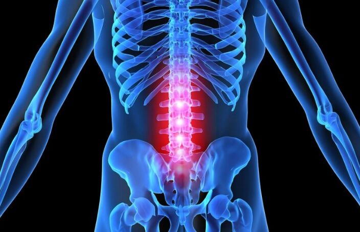 Osteochondrosis vun der Lendegregioun
