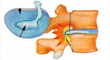 D'Features vun der Entwécklung vu Gebärmutteral Osteochondrosis