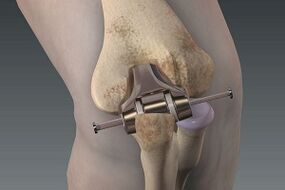 Knie Ersatz fir Arthrosis