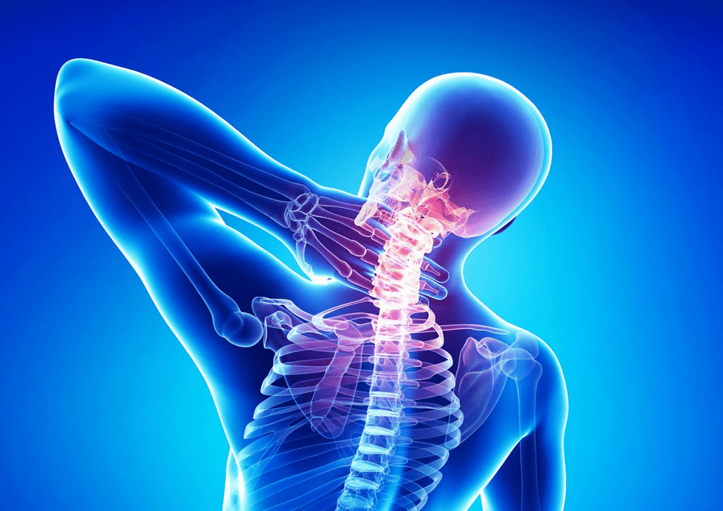 Osteochondrose vun der Wirbelsäule