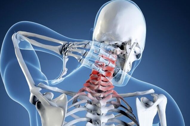 osteochondrosis vun der cervical Wirbelsail